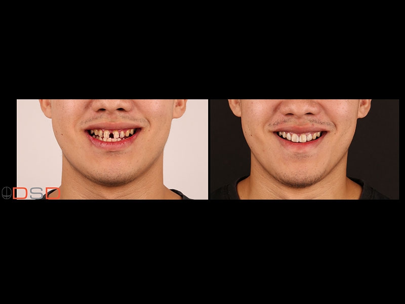 四环素牙染色 跌倒外伤折裂 牙齿形状不美观,例如过小牙,锥形牙(虎牙